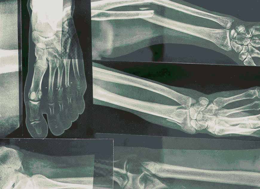 X-rays of bones without signs of fracture of density loss: feet legs arms hands